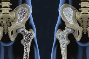 Veja como plano de saúde ajuda no tratamento da Osteoporose!
