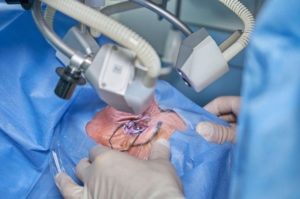 Cirurgia de catarata: 8 dicas para agilizar sua recuperação